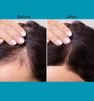 Mesotherapie Anti Hairloss